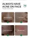 FORT Salicylic Acid Serum – Anti-Acne Face Serum & Dark Spot Correcting Serum for Glowing Skin | Acne Skin Care Products 30ml