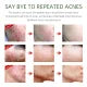 FORT Salicylic Acid Serum – Anti-Acne Face Serum & Dark Spot Correcting Serum for Glowing Skin | Acne Skin Care Products 30ml